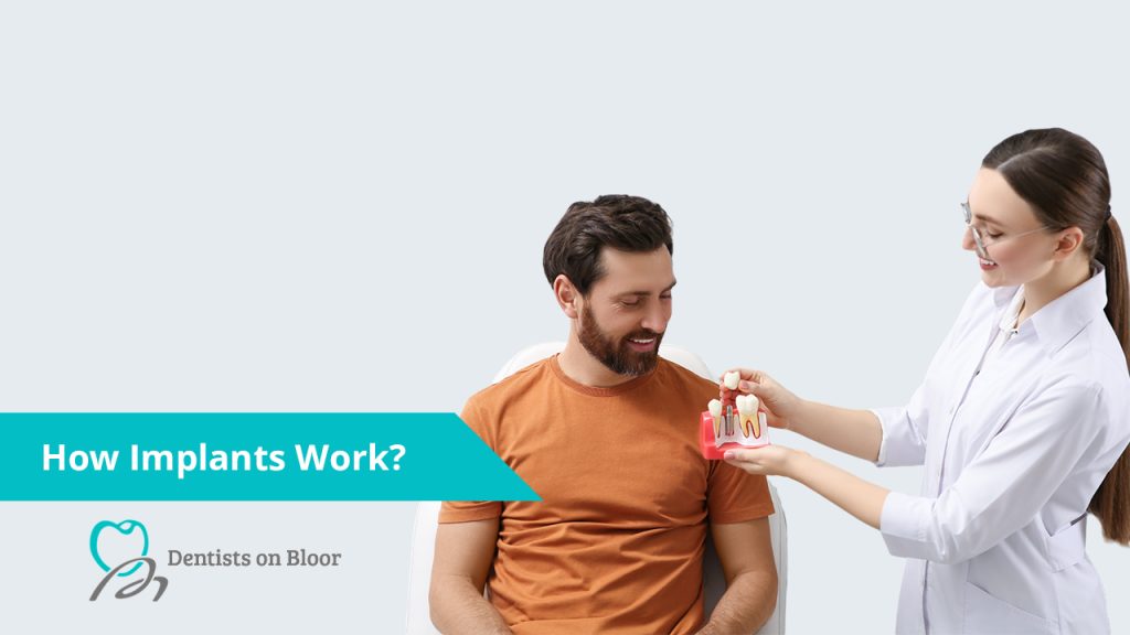 Dental Implant Consultation in Toronto